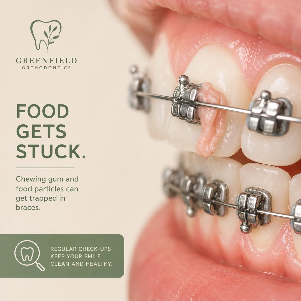 교정 장치에 껌이 낀 모습