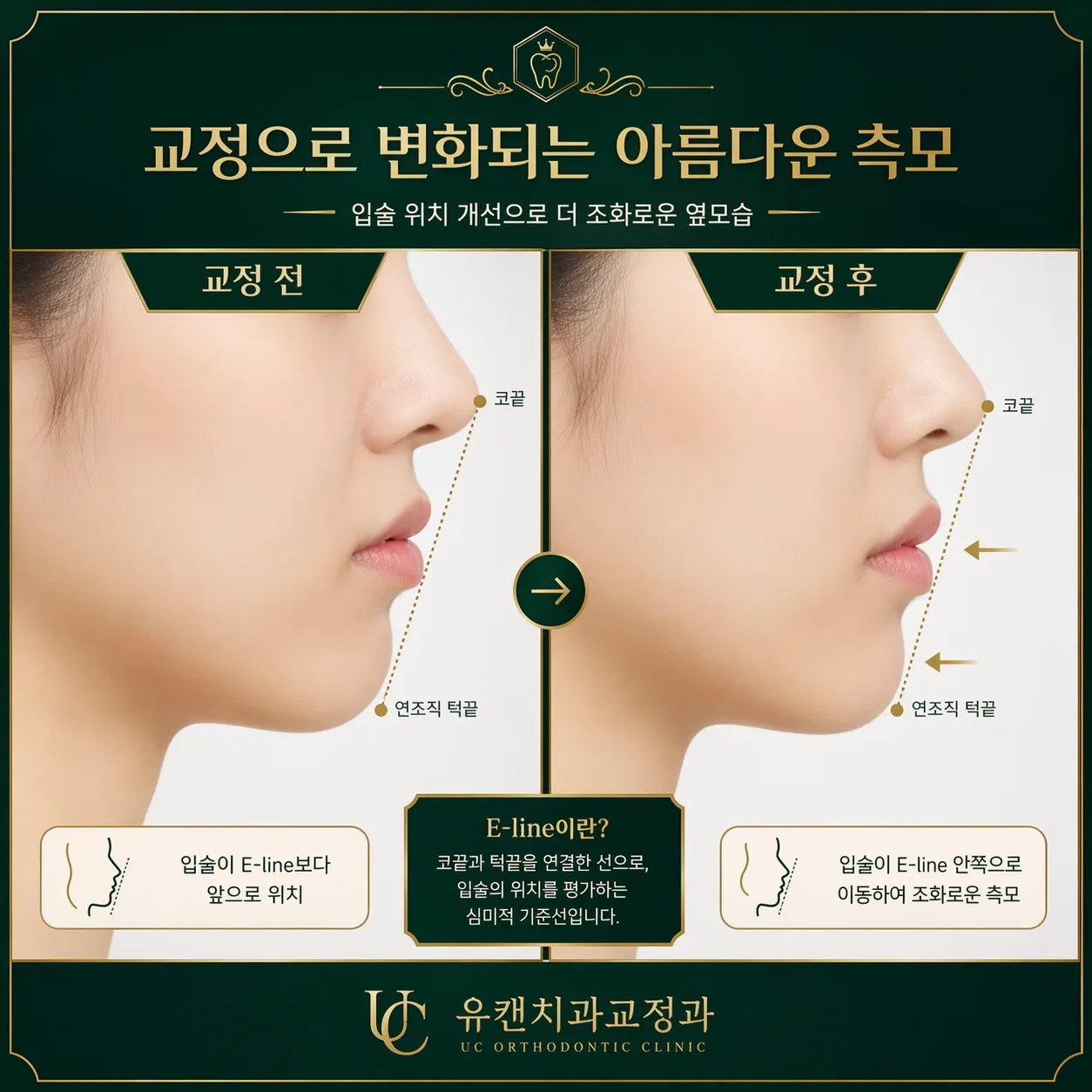 교정 전후 입술 라인 비교