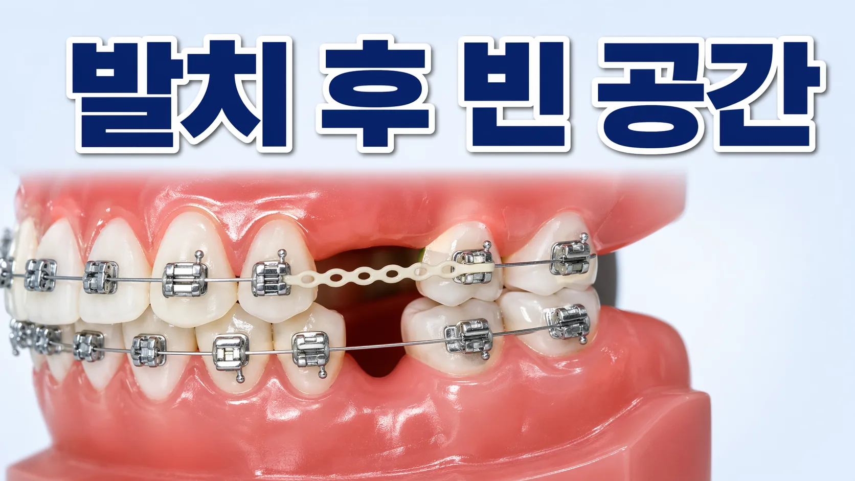 교정 발치 후 빈 공간 언제 닫히나요? 기간과 과정