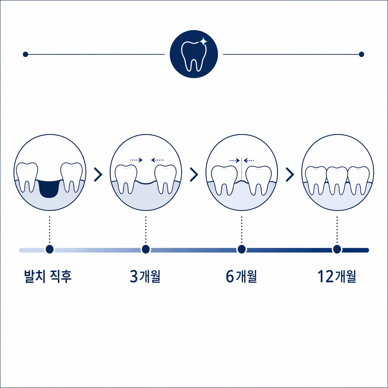 발치 공간 닫히는 타임라인