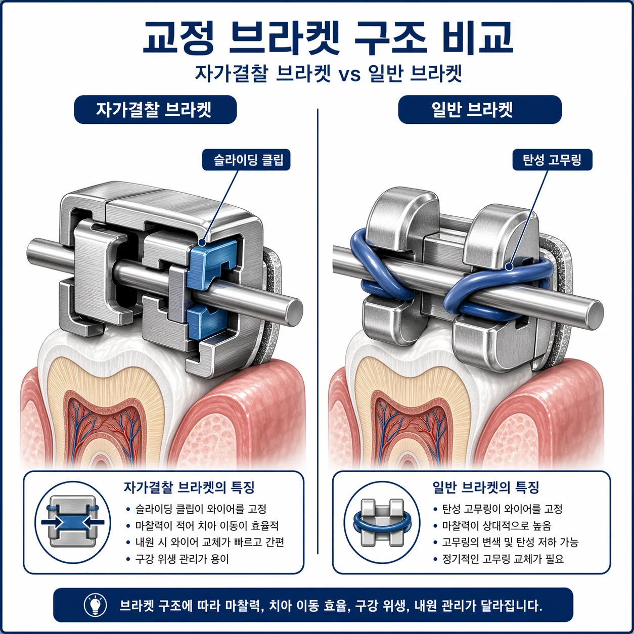 브라켓 구조 비교