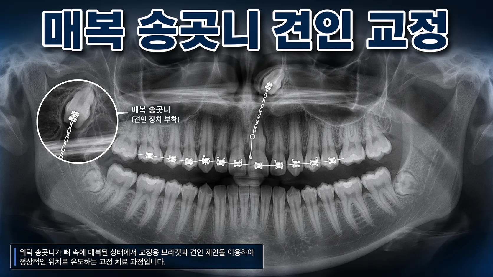 매복 송곳니, 뽑지 않고 끌어내리는 방법 | 교정전문의