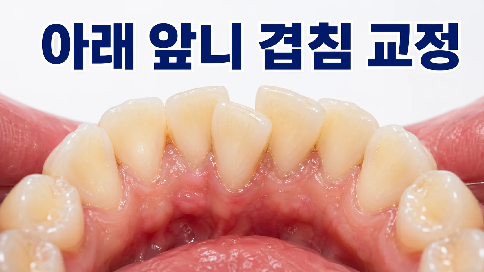 아래 앞니 겹쳐서 올라왔어요, 교정 꼭 해야 할까요? | 교정전문의