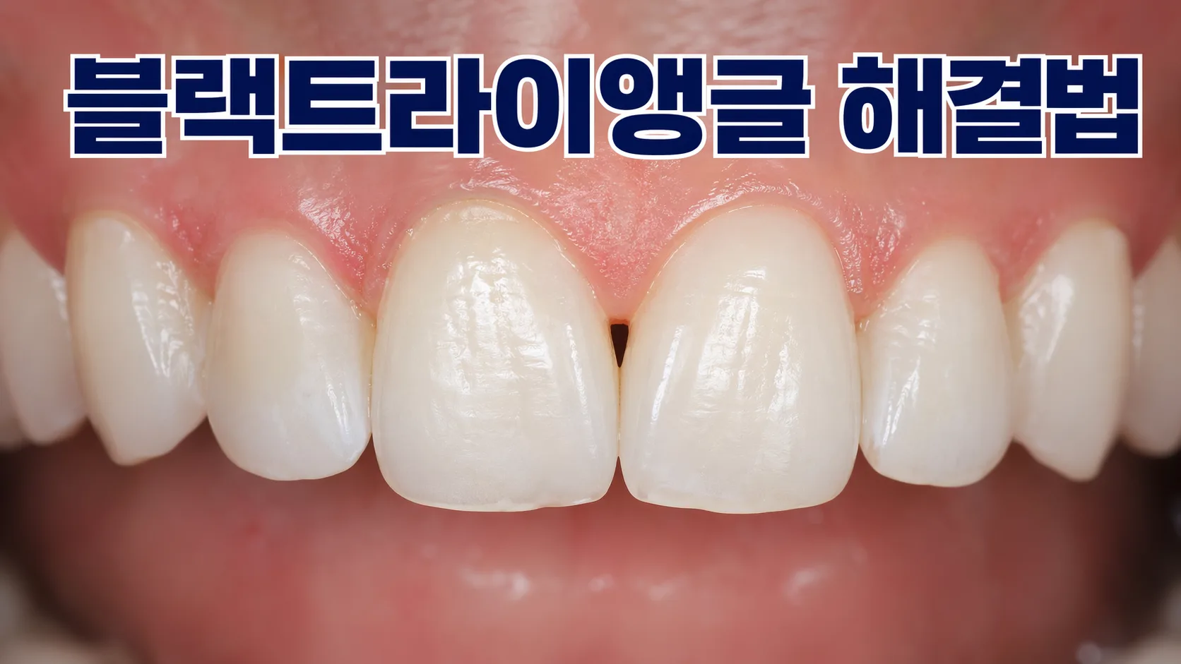 교정 중 이 사이에 생긴 검은 삼각형(블랙트라이앵글), 원인과 해결법