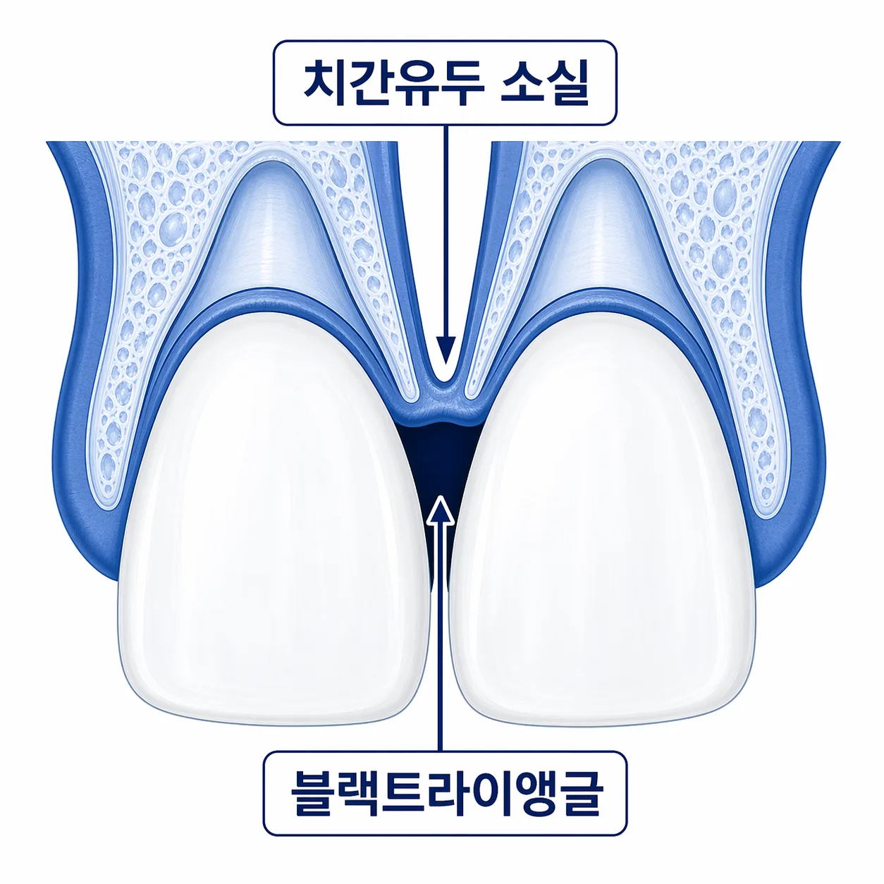 블랙트라이앵글 다이어그램