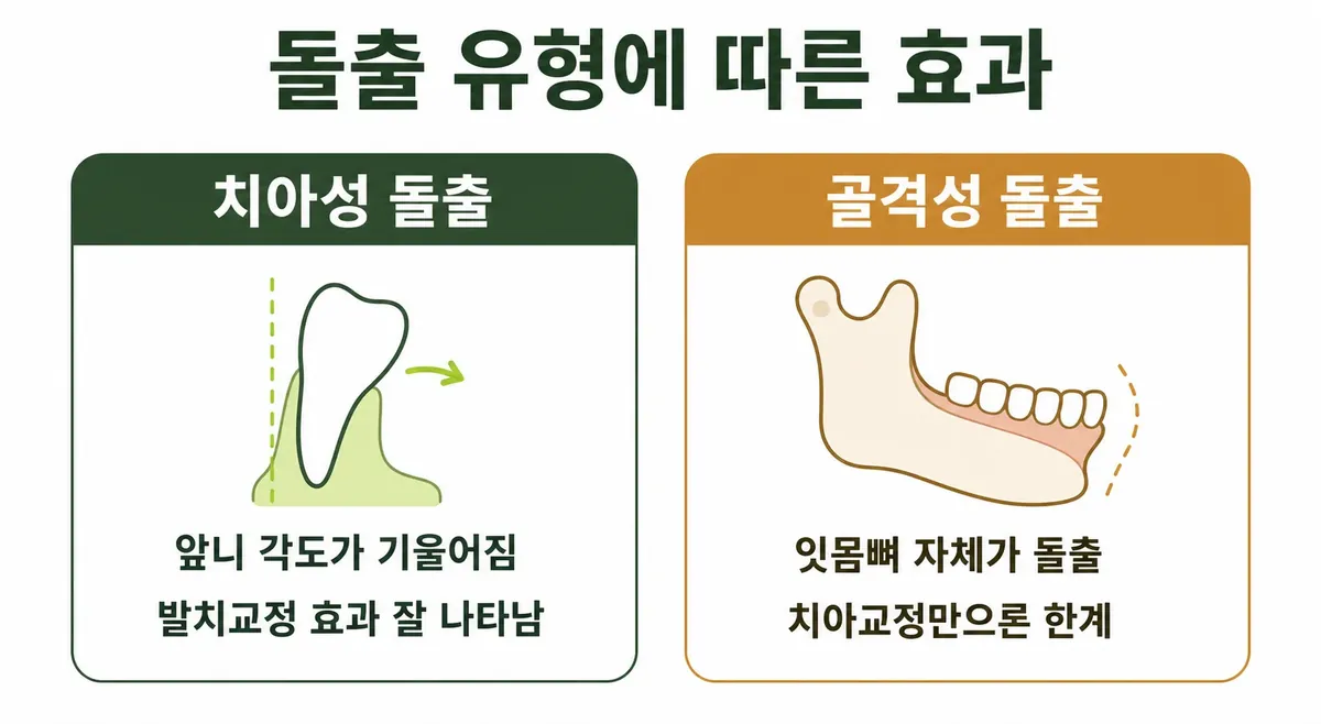 돌출입 발치교정으로 달라지는 입매, E라인, 옆모습 변화 인포그래픽