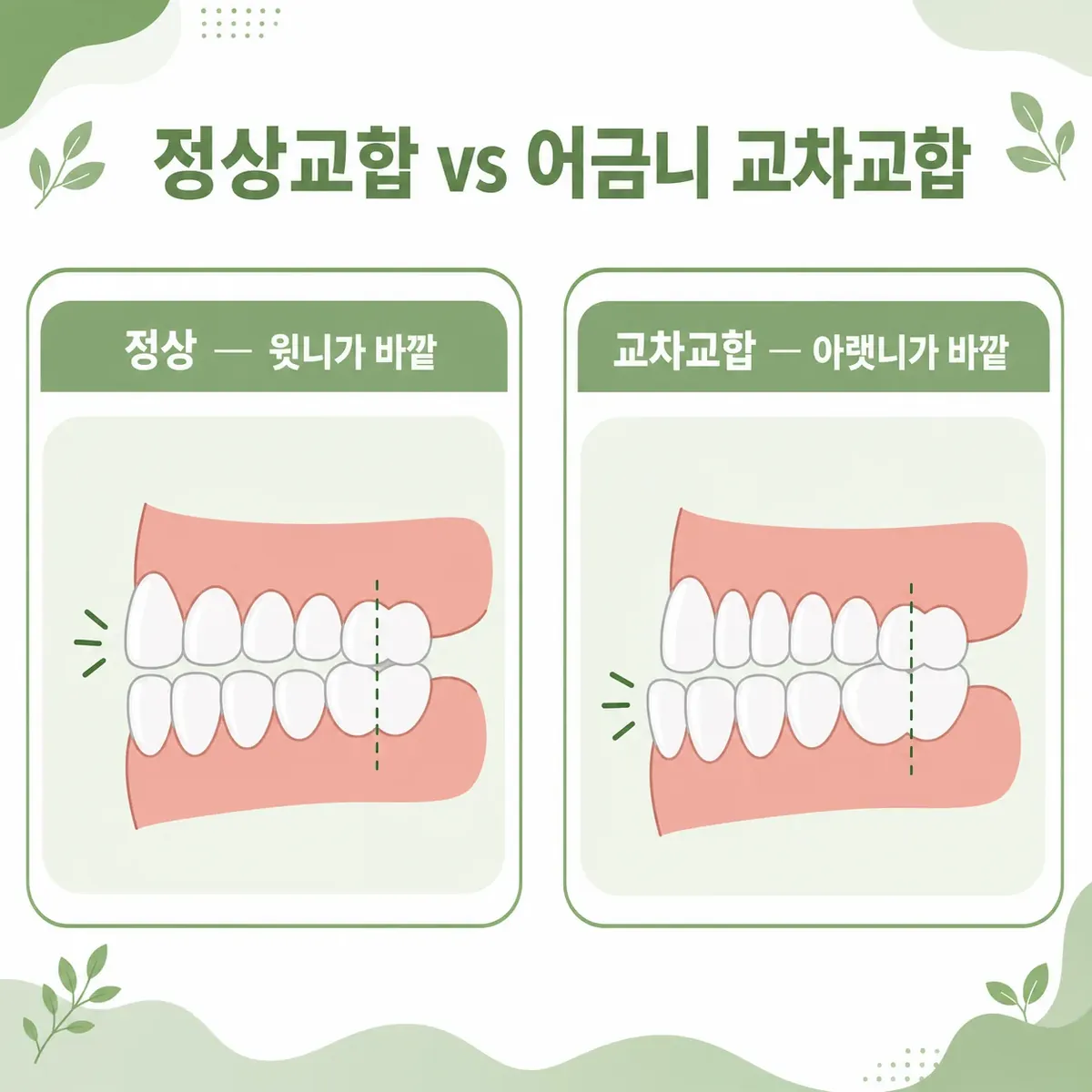 정상교합과 어금니 교차교합 비교 인포그래픽