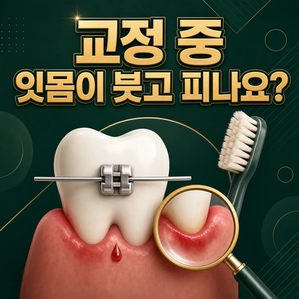 교정 중 잇몸 염증