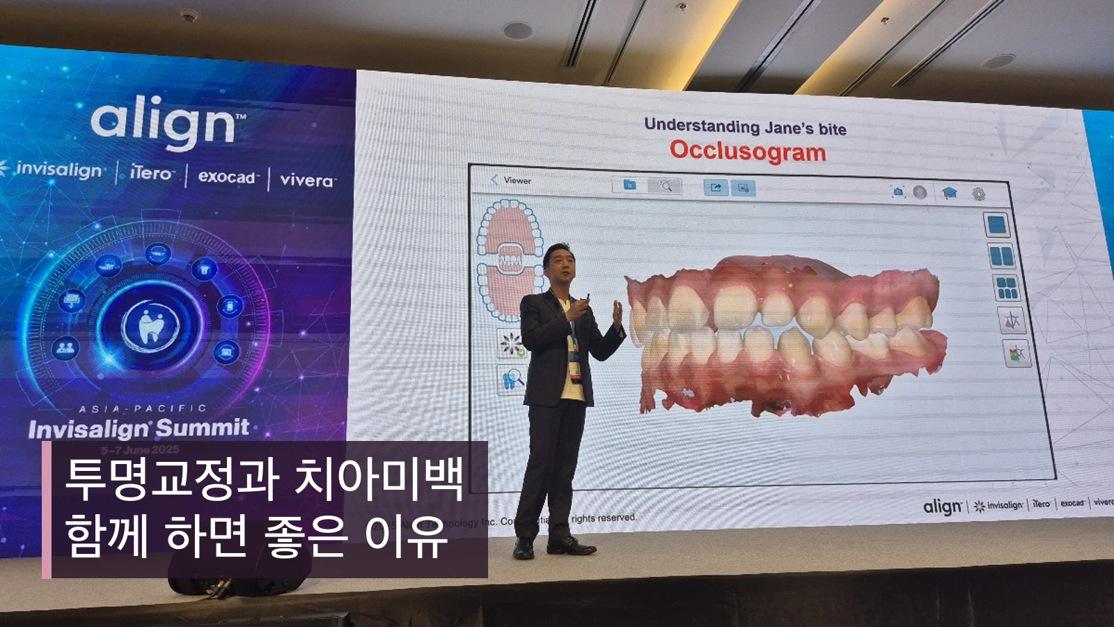 투명교정과 치아미백 함께 하면 좋은 이유