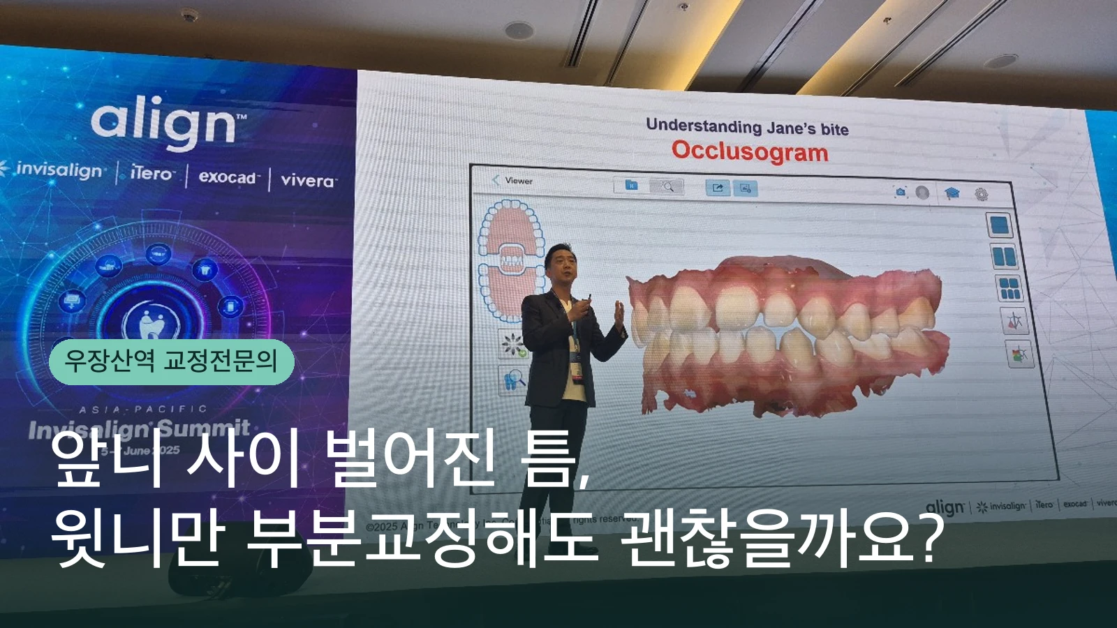 앞니 사이 벌어진 틈, 윗니만 부분교정해도 괜찮을까요?